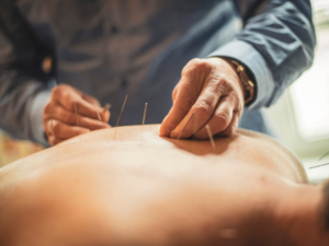 Acupuncture Close Up Image